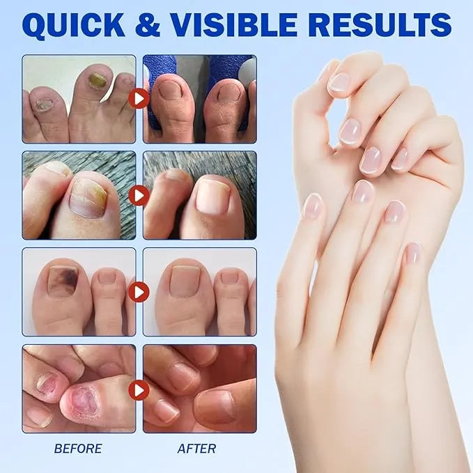 Fungal Nail Treatment Patches – Fast-Acting Antifungal Repair for Healthy Nails