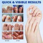 Fungal Nail Treatment Patches – Fast-Acting Antifungal Repair for Healthy Nails