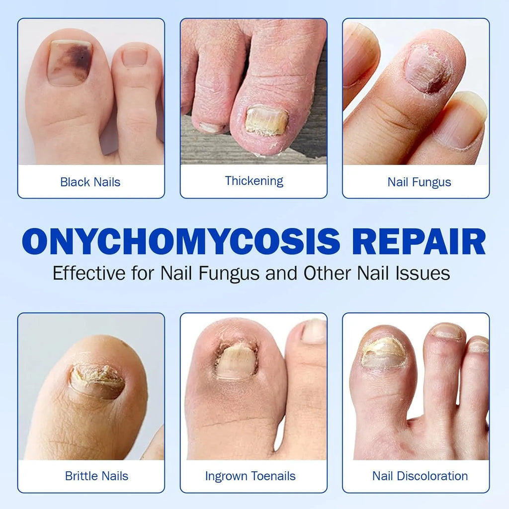 Fungal Nail Treatment Patches – Fast-Acting Antifungal Repair for Healthy Nails