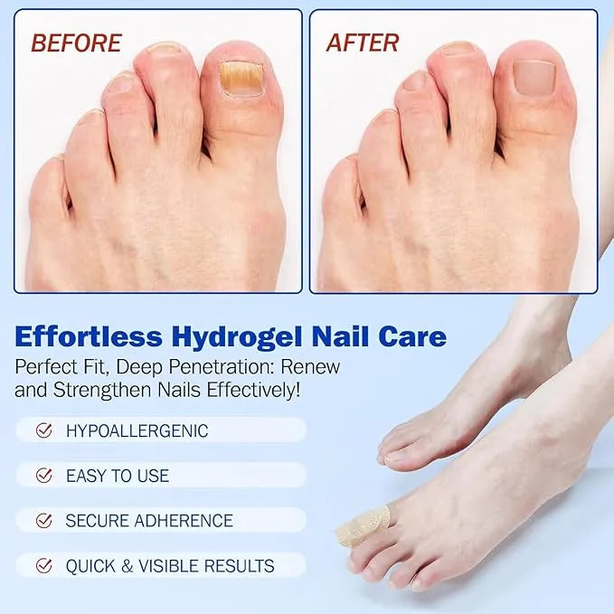 Fungal Nail Treatment Patches – Fast-Acting Antifungal Repair for Healthy Nails